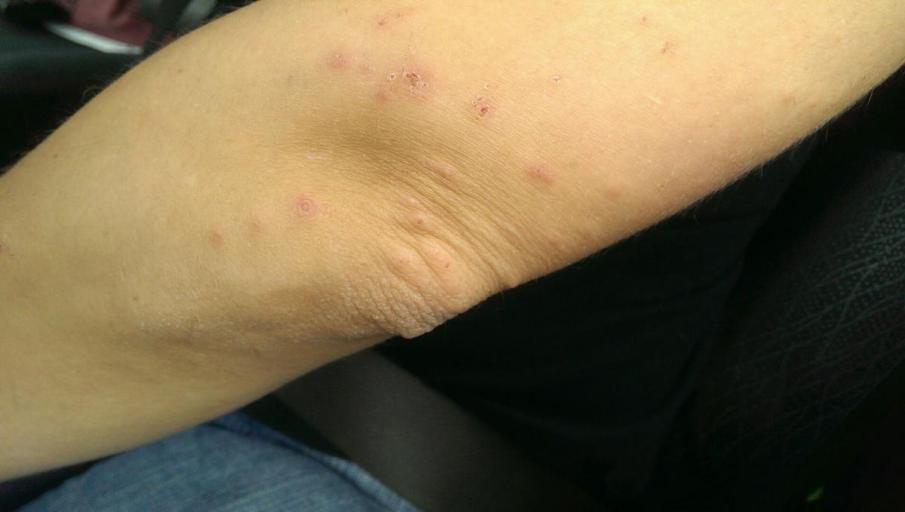 Bites on arm from San Fransisco Airport